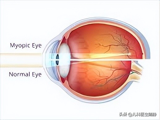 儿童近视有什么方法？关于儿童近视的知识点