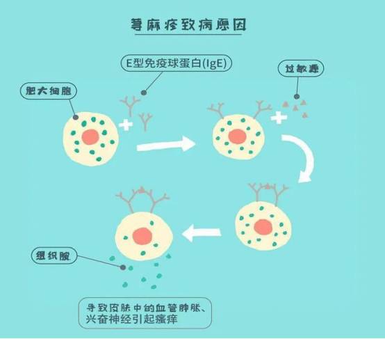 奥马珠单抗治疗荨麻疹效果怎么样？