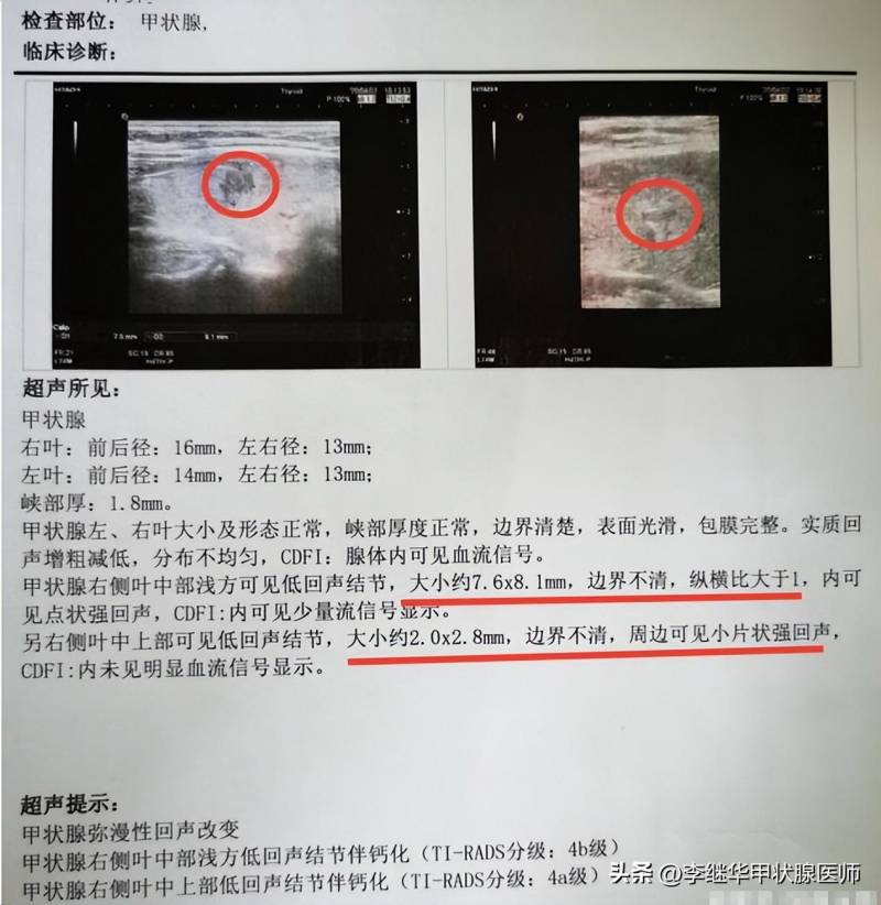 纵横比>1的甲状腺结节什么意思？