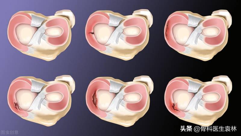 半月板损伤怎么治疗比较好得快？