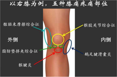 膝关节内侧疼痛的原因和治疗方法，膝关节内侧疼但不知道什么原因？