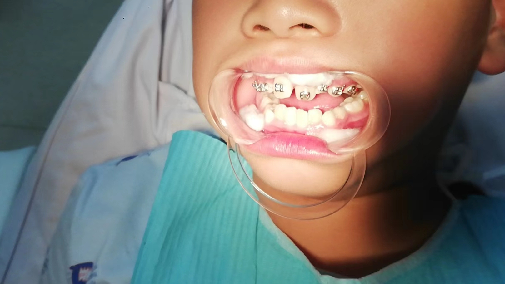 男孩需要矫正牙齿吗？从小男孩人生中的靠前次牙齿矫正经历谈谈牙齿的正畸