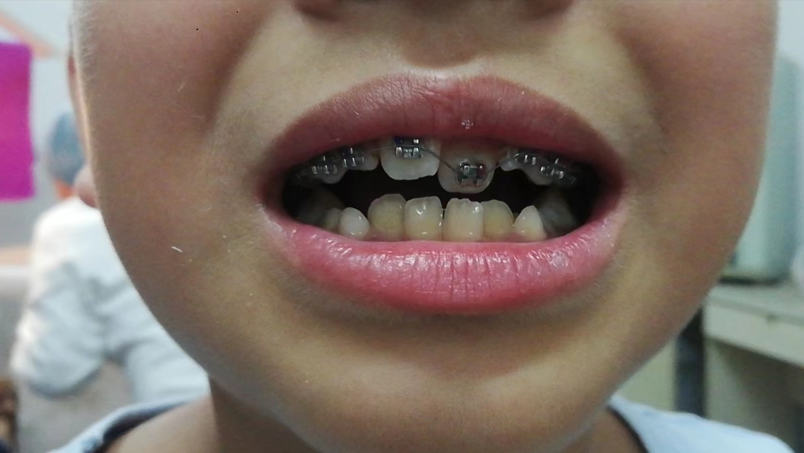 男孩需要矫正牙齿吗？从小男孩人生中的靠前次牙齿矫正经历谈谈牙齿的正畸